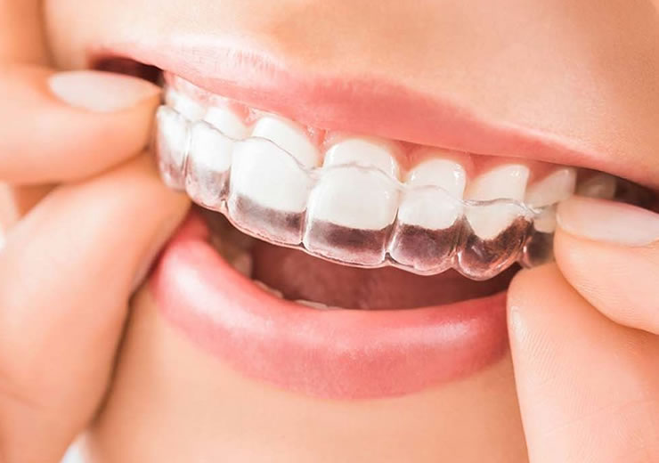 invisalign